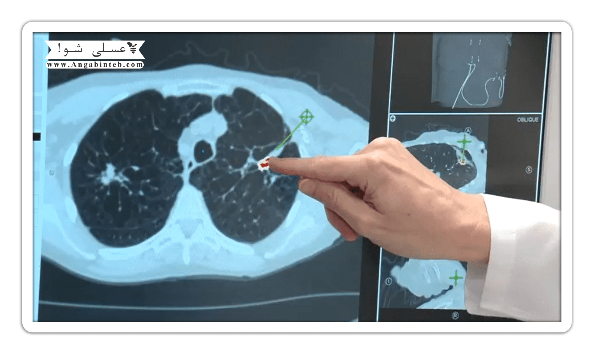 lung cancer-avamel khatar.